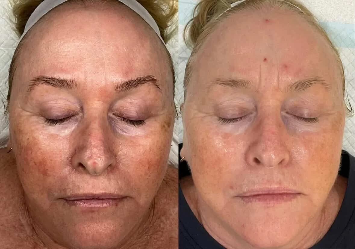 Before and after — Pigmentation skin treatment at Sculpt Aesthetics