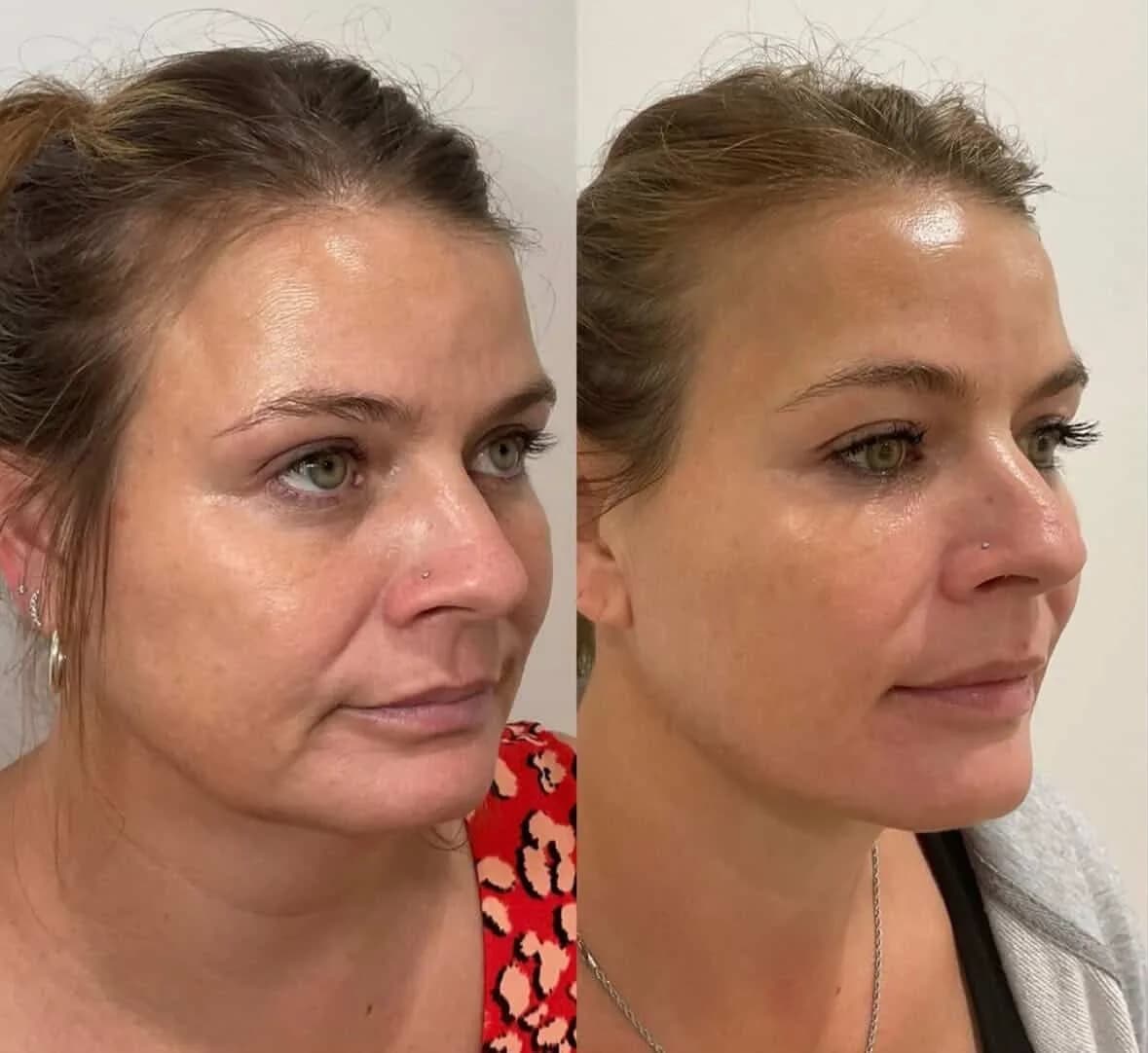 Before and after — Premature ageing skin treatment at Sculpt Aesthetics
