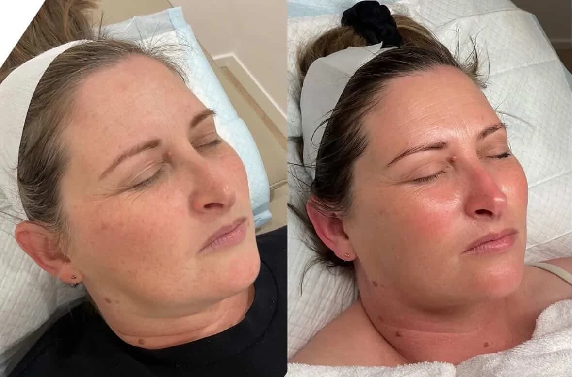 Before and after — Dull, dehydrated skin treatment at Sculpt Aesthetics
