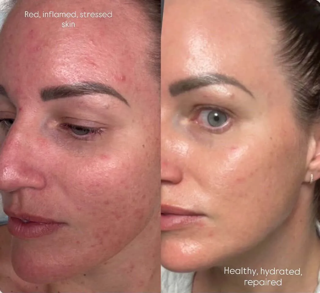 Before and after — Barrier repair skin treatment at Sculpt Aesthetics