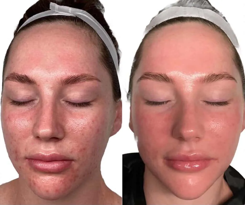 Before and after — Acne & skin texture skin treatment at Sculpt Aesthetics