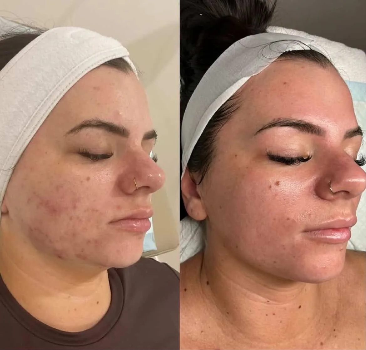 Before and after — Acne skin treatment at Sculpt Aesthetics