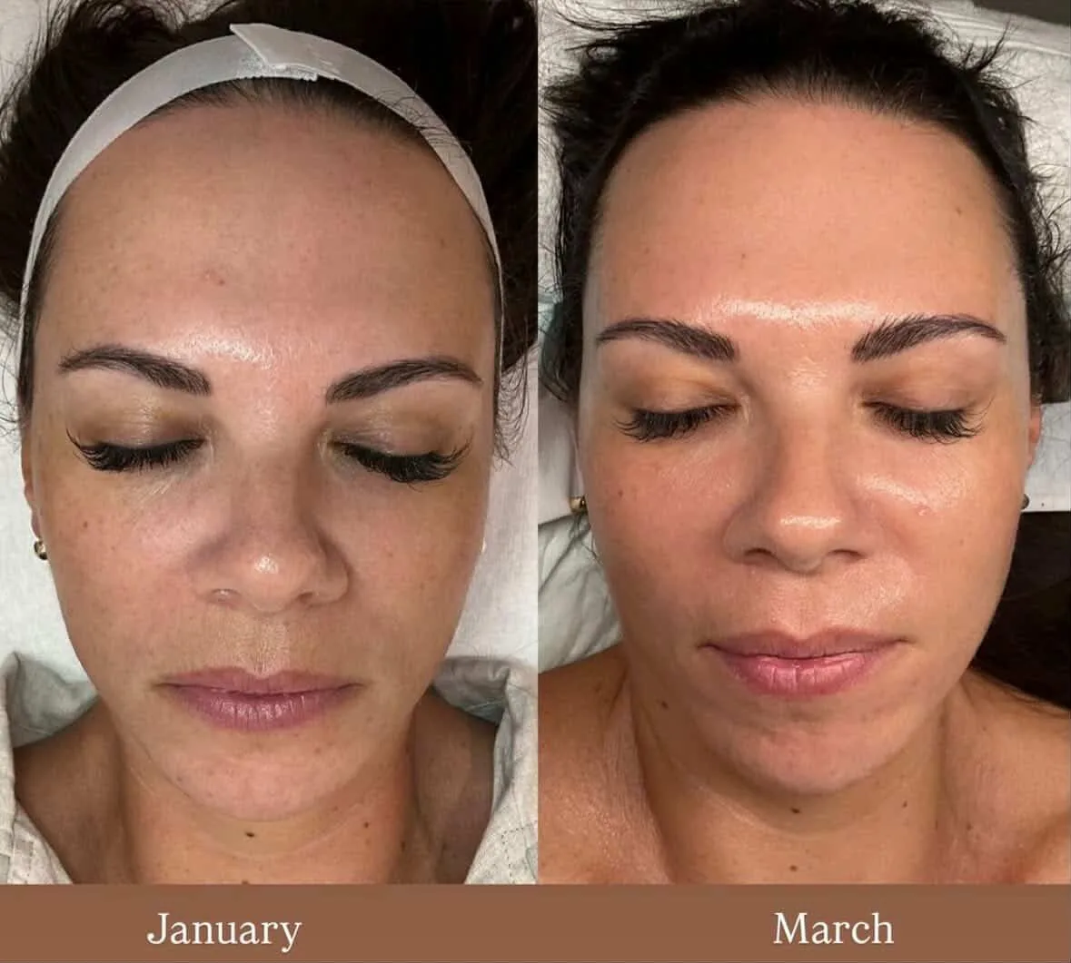 Before and after — Brightness & skin health skin treatment at Sculpt Aesthetics