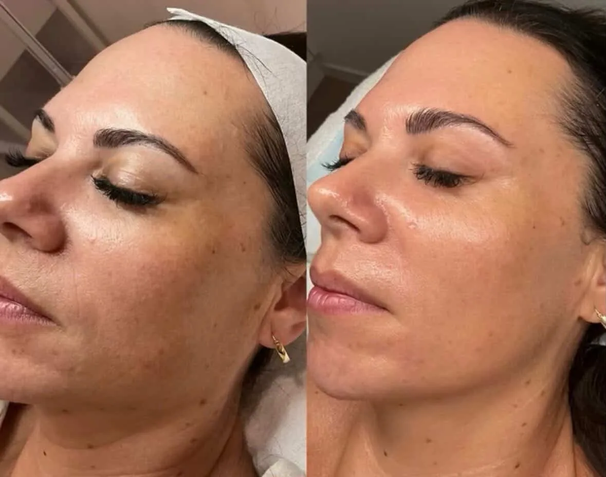 Before and after — Pigmentation & texture skin treatment at Sculpt Aesthetics