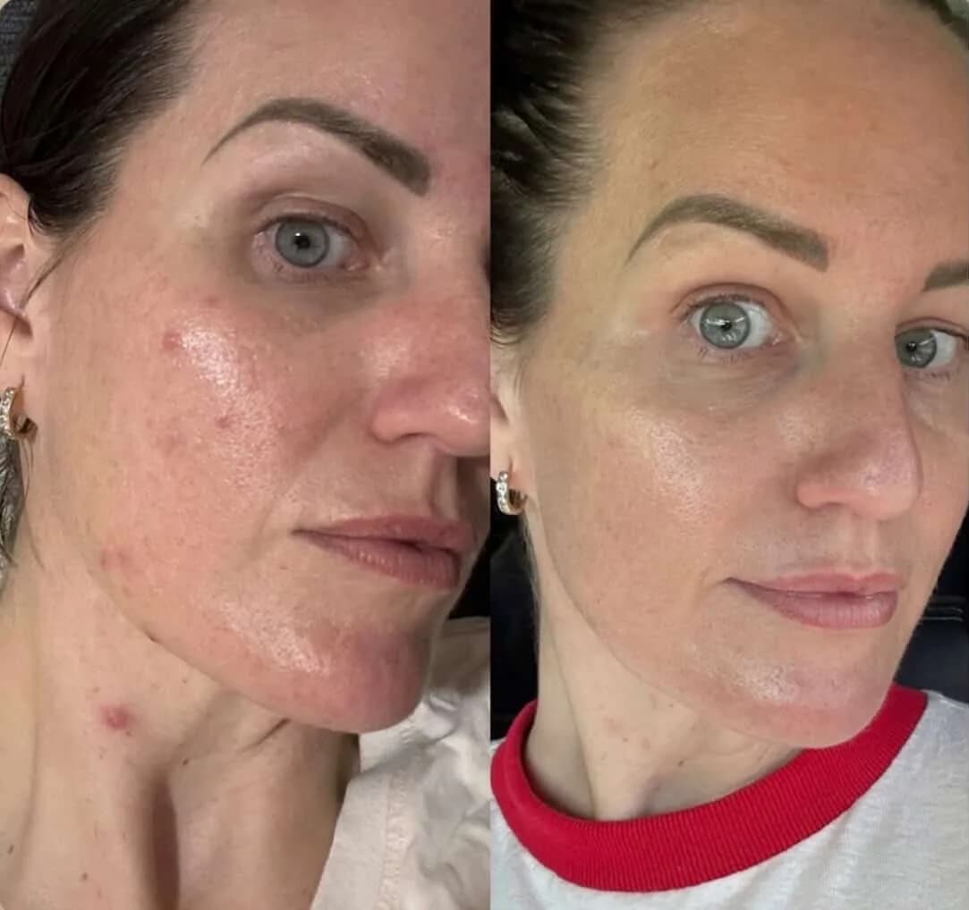 Before and after — Acne & inflammation skin treatment at Sculpt Aesthetics