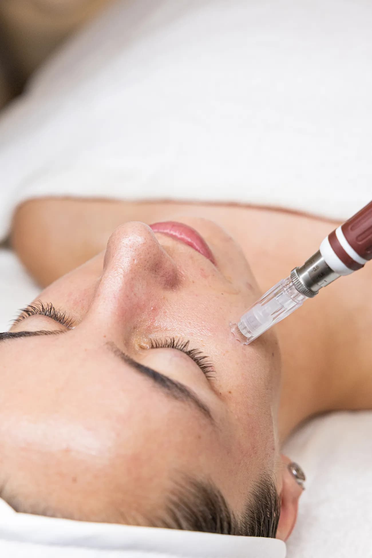 Microneedling treatment at Sculpt Aesthetics