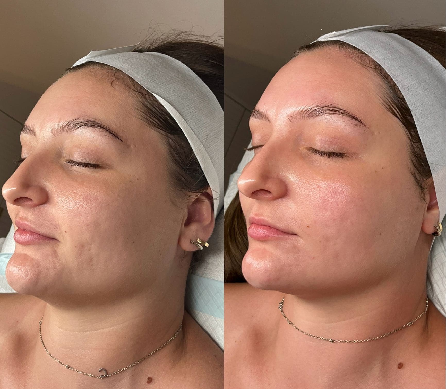 Before and after — Scarring skin treatment at Sculpt Aesthetics